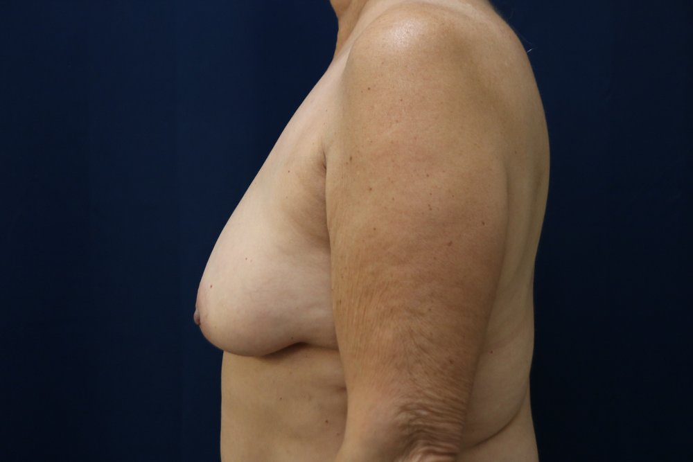 Forever Breast® Natural Augmentation before