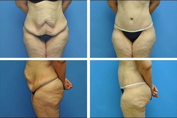 Tummy tuck before and after Beverly Hills - patient 1