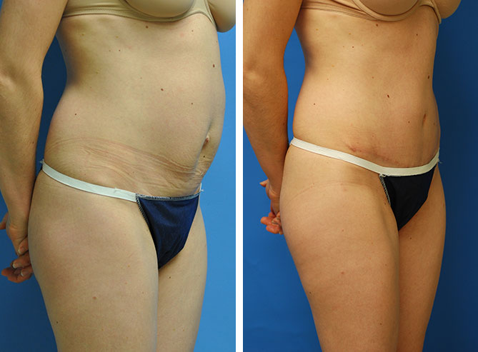 Tummy tuck before and after Beverly Hills - patient 2