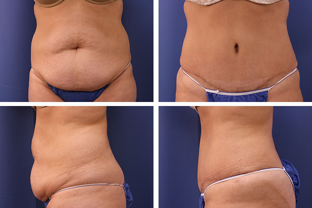 Tummy tuck before and after Beverly Hills - patient 3