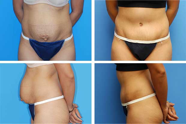 Tummy tuck before and after Beverly Hills - patient 4