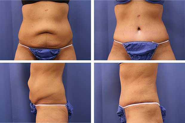 Tummy tuck before and after Beverly Hills - patient 5