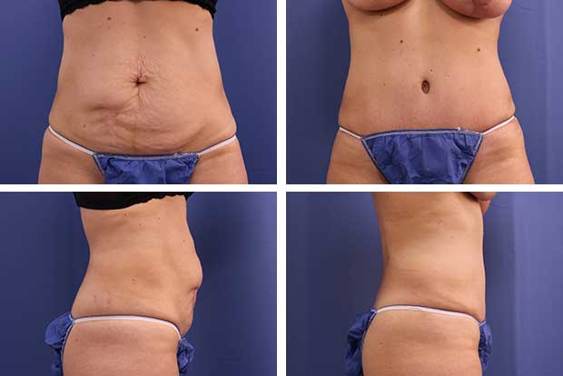 Tummy tuck before and after Beverly Hills - patient 6