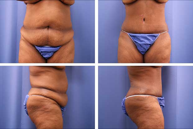 Tummy tuck before and after Beverly Hills - patient 7