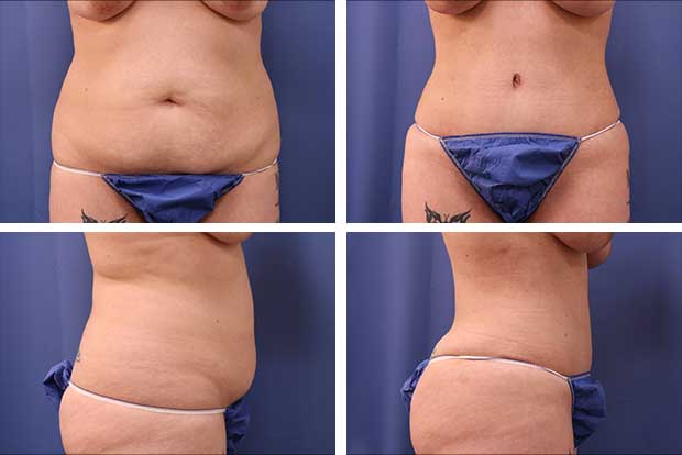 Tummy tuck before and after Beverly Hills - patient 8