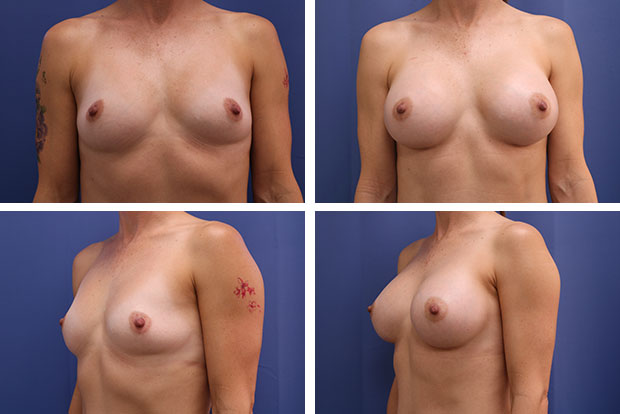 Breast Augmentation After