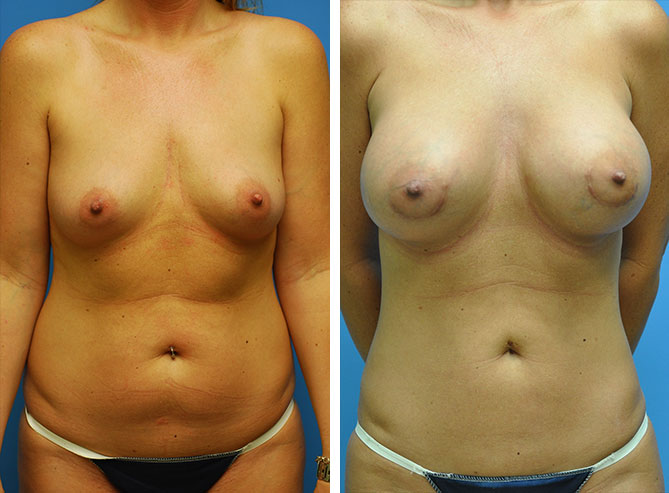 Breast augmentation after