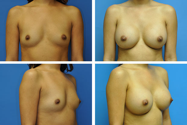 Breast Augmentation Before