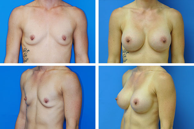 Breast Augmentation After