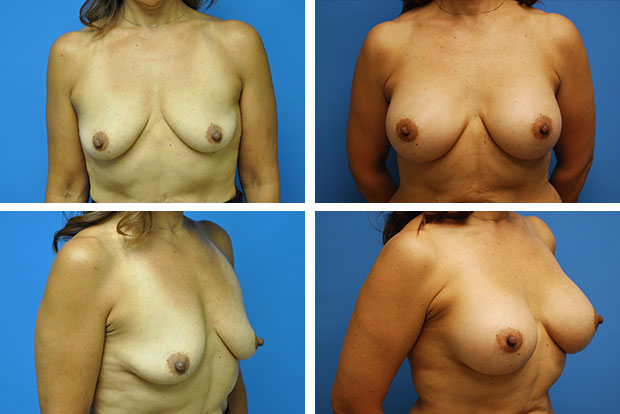 Breast Augmentation Before