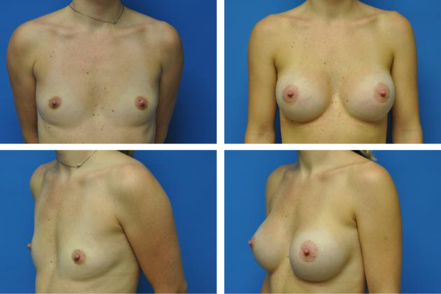 Breast implant revision before and after Beverly Hills – patient 1
