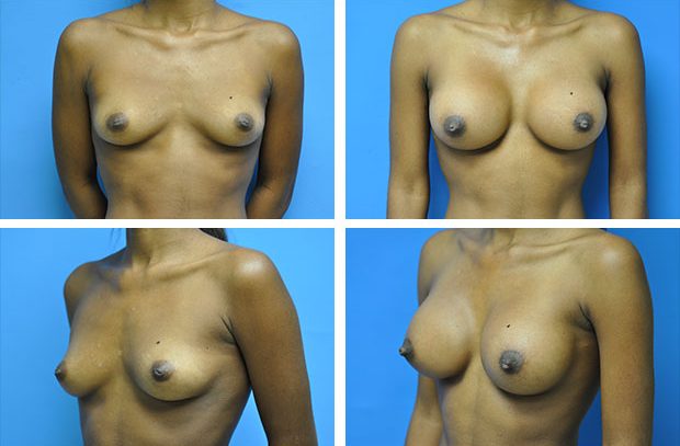 Breast implant revision before and after Beverly Hills – patient 2