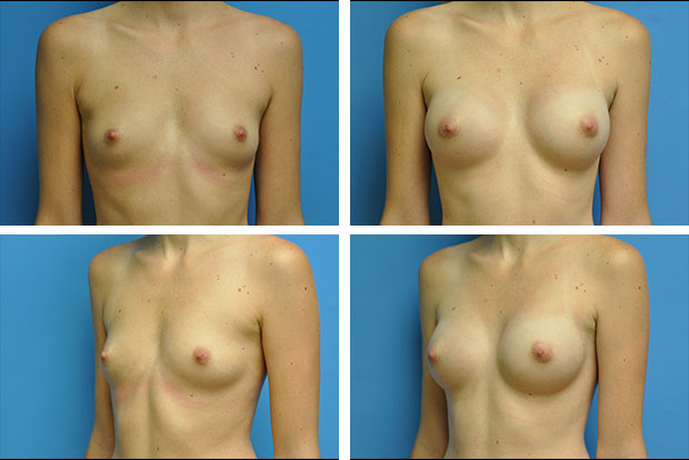 Breast implant revision before and after Beverly Hills – patient 3