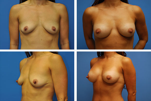 Breast implant revision before and after Beverly Hills – patient 4