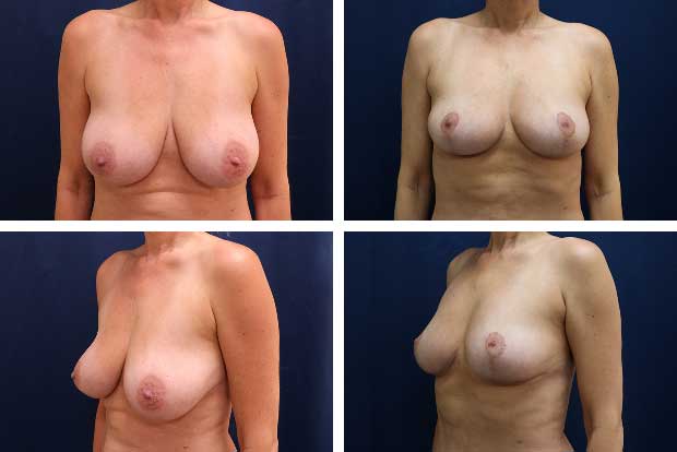 Breast lift after