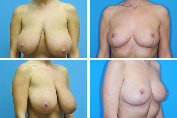 Breast reduction before and after Beverly Hills – patient 2