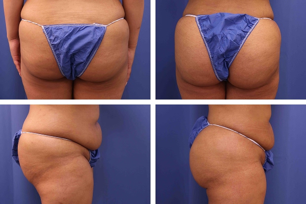 Butt augmentation before and after Beverly Hills – patient 2