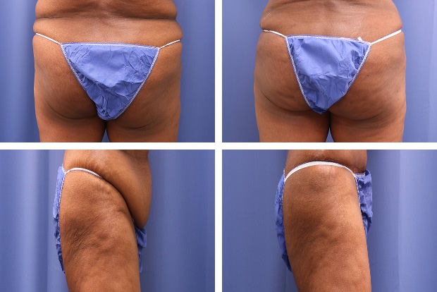 Butt augmentation before and after Beverly Hills – patient 3