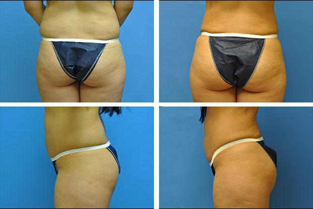 Butt augmentation before