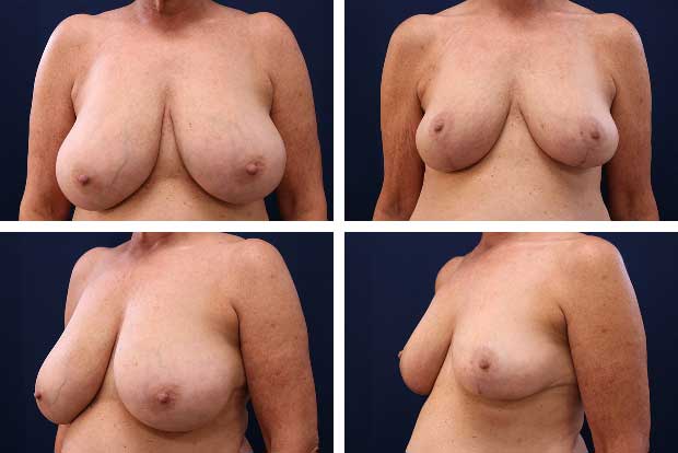 Eyelid surgery before and after Beverly Hills — patient 4