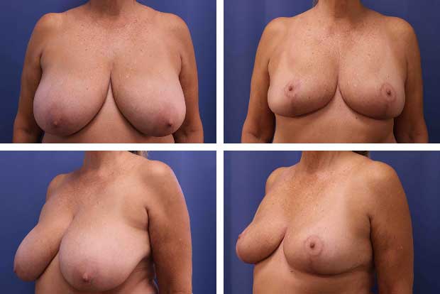 Eyelid surgery before and after Beverly Hills — patient 5