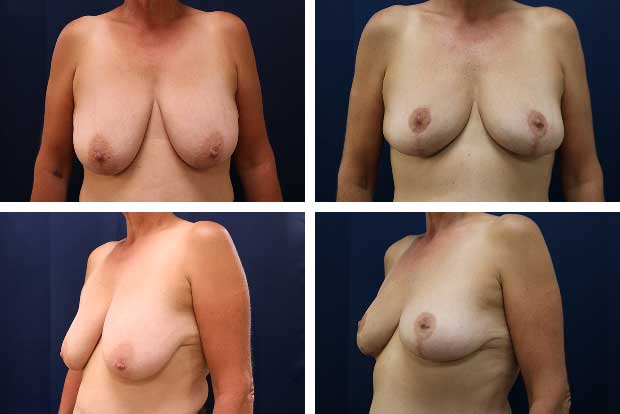 Facelift before and after Beverly Hills — patient 3