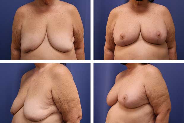 Facelift before and after Beverly Hills — patient 4