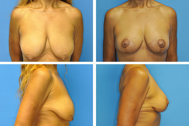 Facelift before and after Beverly Hills — patient 5