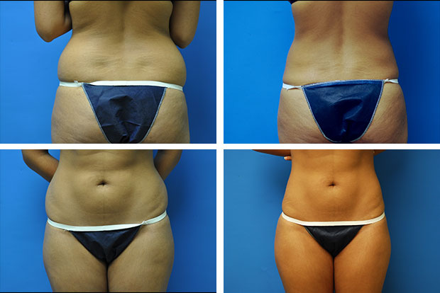 Liposuction before and after Beverly Hills – patient 1