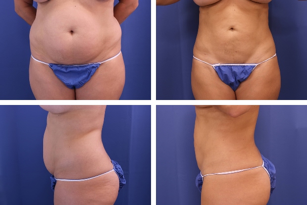 Liposuction After