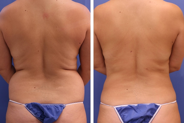 Liposuction before and after Beverly Hills – patient 3