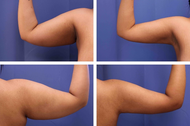 Liposuction before and after Beverly Hills – patient 4
