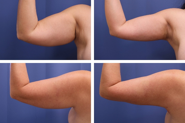 Liposuction before and after Beverly Hills – patient 5