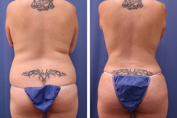 Liposuction before and after Beverly Hills – patient 6