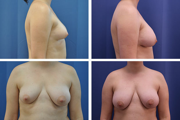 Natural breast augmentation after