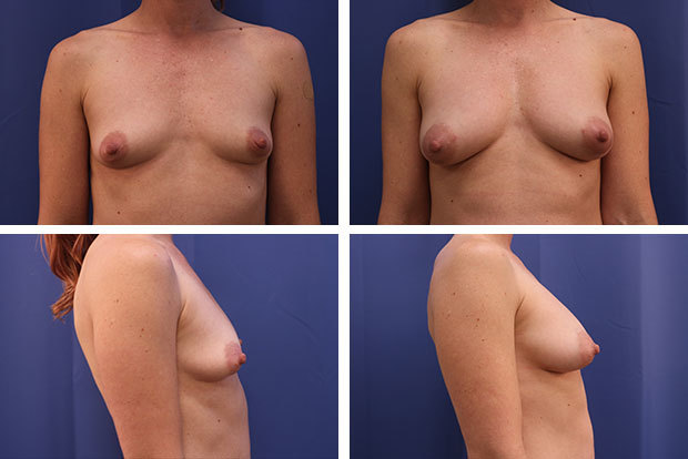 Forever Breast fat transfer augmentation result - patient 1