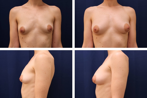 Forever Breast fat transfer augmentation result - patient 4