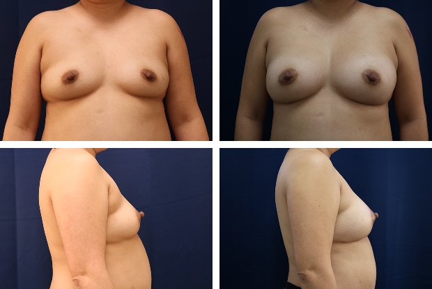 Forever Breast fat transfer augmentation result - patient 5