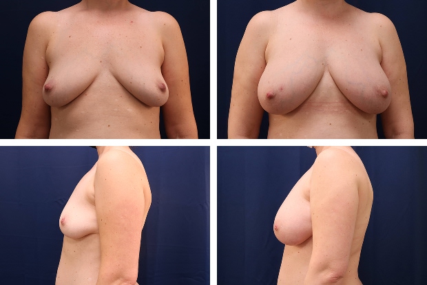 Forever Breast fat transfer augmentation result - patient 6